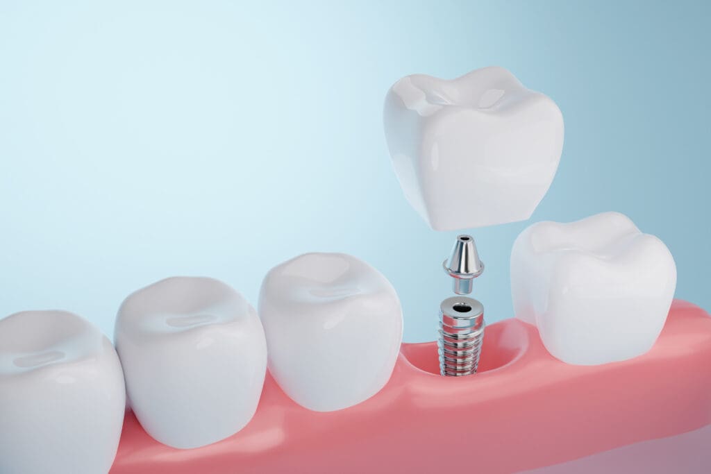 Implant Placement FAQ Skokie IL