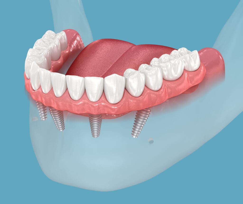 Implant Overdenture Skokie, IL