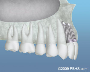 Implant placed