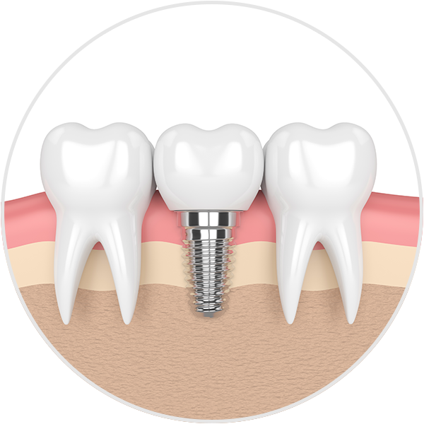 Implant