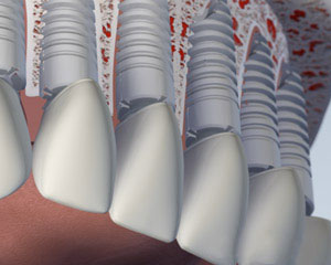 upper implants