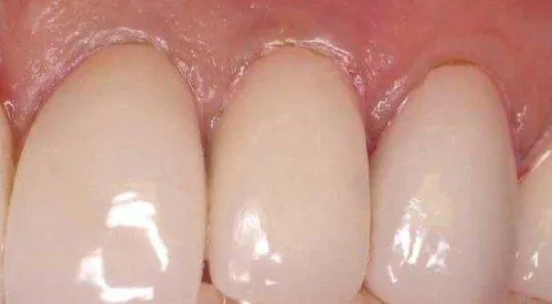 After Dental Implant