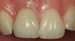 After Dental Implants