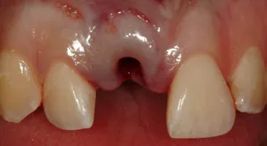 Before Dental Implant