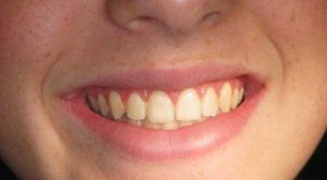 after Gum Reduction