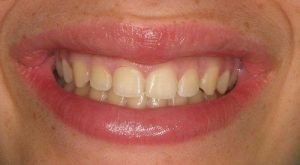 Before Gum Reduction