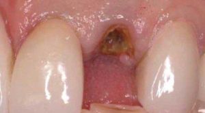 Before Dental Implants