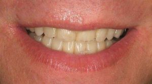 After Same Day Smile