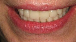 After Same Day Smile