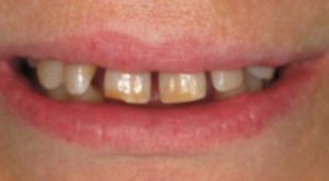 Before Same Day Smile