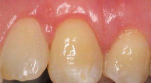After Tissue Graft