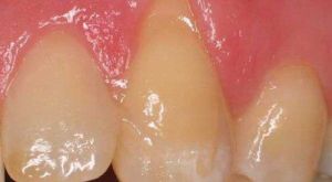 Before Tissue Graft